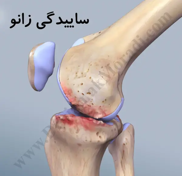 عکس طب سوزنی زانو