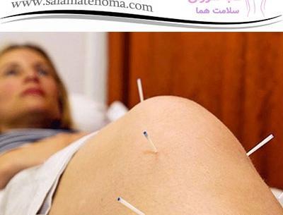 عکس طب سوزنی زانو