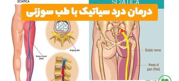عکس طب سوزنی زانو