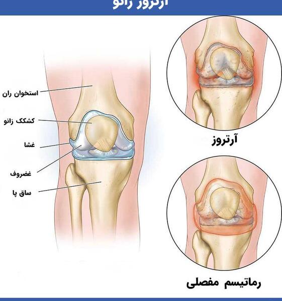 عکس طب سوزنی زانو