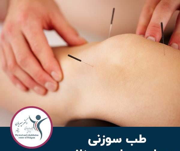 عکس طب سوزنی زانو