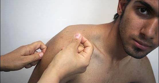 عکس از طب سوزنی