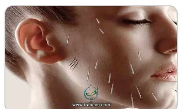 عکس از طب سوزنی