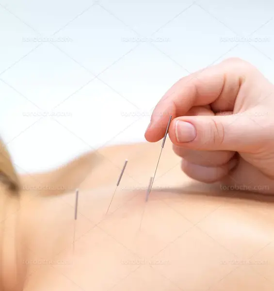 عکس از طب سوزنی