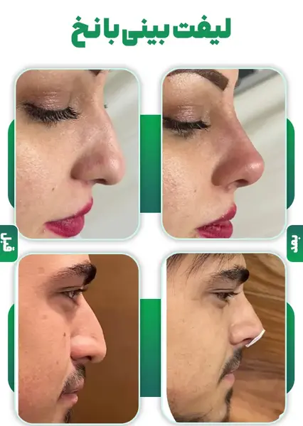عکس قبل و بعد چربی سوزی بینی
