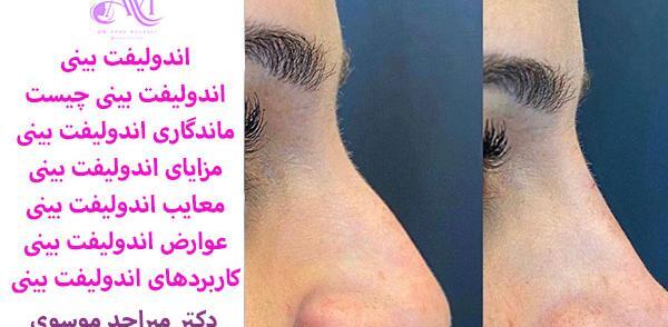 عکس قبل و بعد چربی سوزی بینی