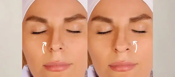 عکس قبل و بعد چربی سوزی بینی