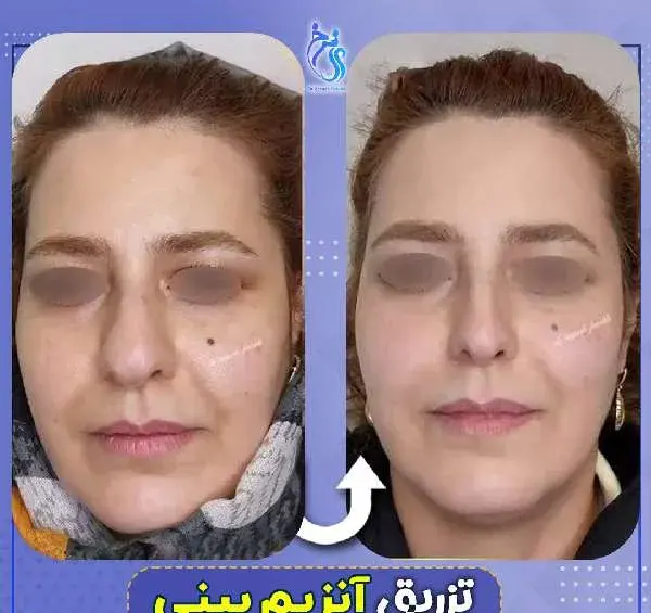 عکس قبل و بعد چربی سوزی بینی