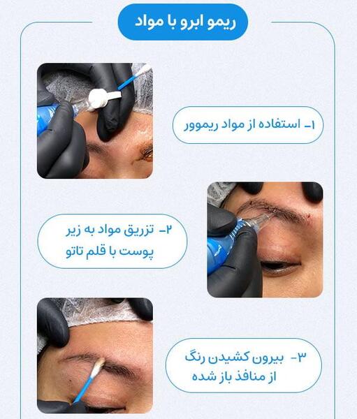 عکس لیزر تاتو ابرو با دستگاه کیوسوئیچ
