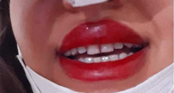 عکس مراقبت بعد از تاتو لب نی نی سایت