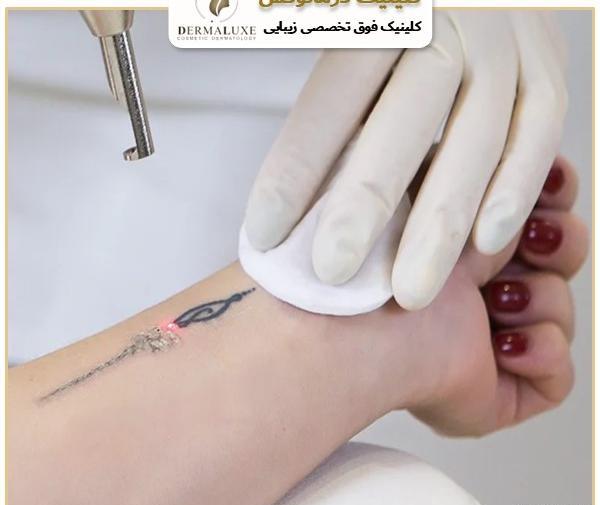 عکس لیزر تاتو کرج