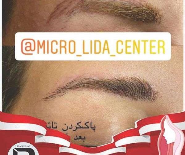 عکس لیزر تاتو کرج