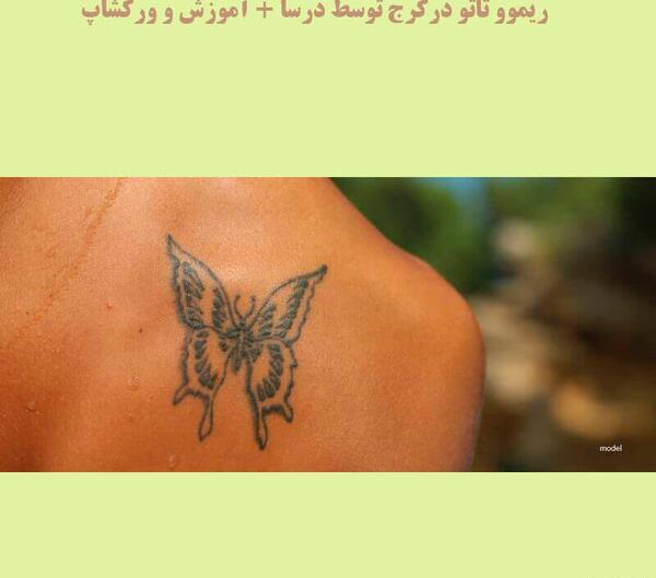 عکس لیزر تاتو کرج