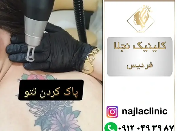 عکس لیزر تاتو کرج