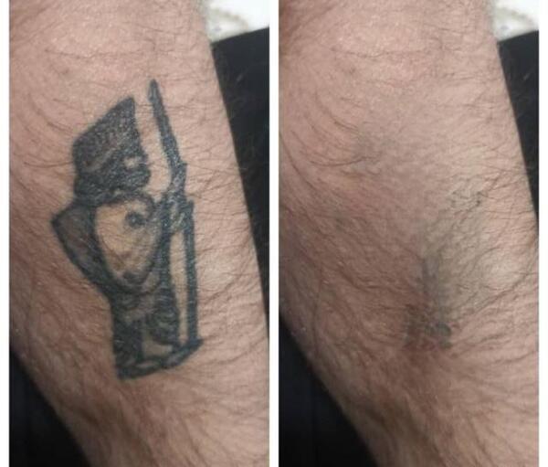 عکس لیزر تاتو اصفهان