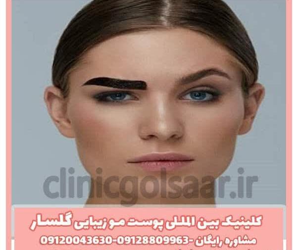 عکس لیزر تاتو ابرو چند جلسه است