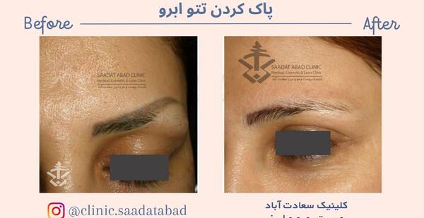عکس لیزر تاتو ابرو چند جلسه است