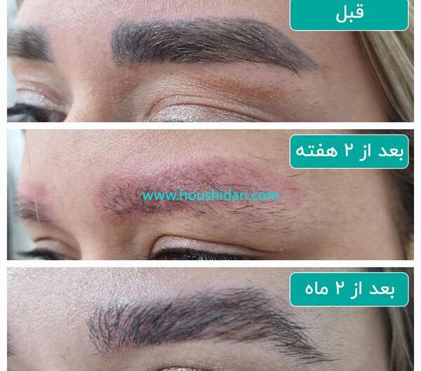 عکس لیزر تاتو ابرو چند جلسه است