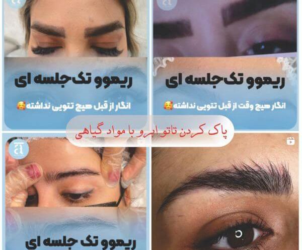 عکس لیزر تاتو ابرو چند جلسه است