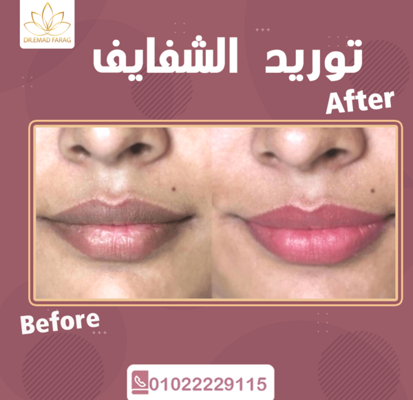 عکس تاتو شفايف قبل وبعد