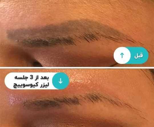 عکس تاتو زدن ابرو