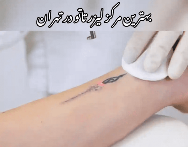 عکس لیزر تاتو در تهران