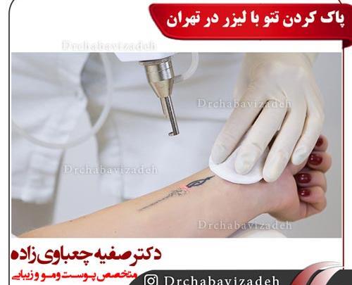 عکس لیزر تاتو در تهران