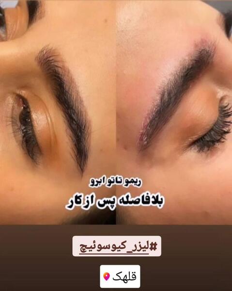 عکس لیزر تاتو در تهران
