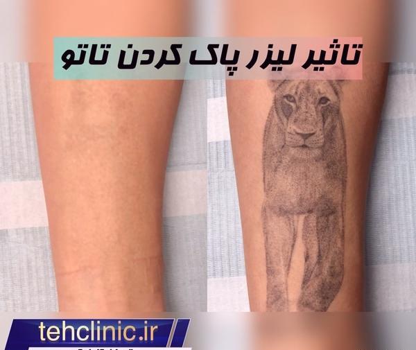 عکس لیزر تاتو تهران
