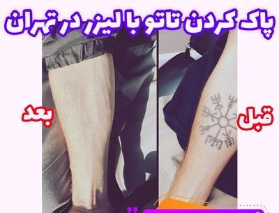 عکس لیزر تاتو تهران