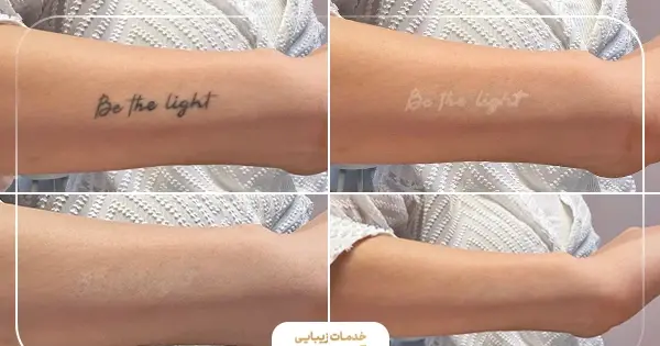 عکس لیزر تاتو تهران