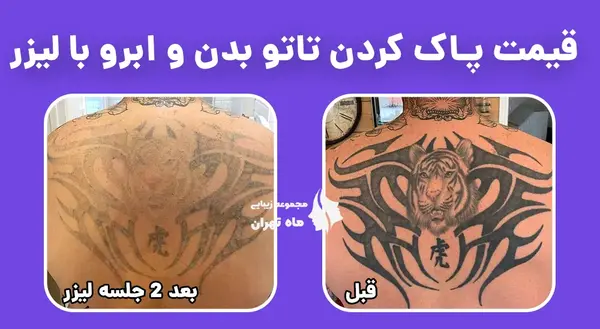 عکس لیزر تاتو تهران