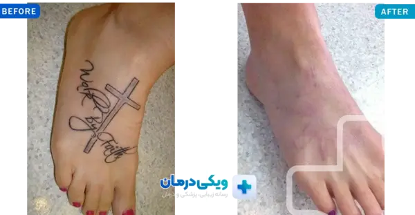 عکس لیزر تاتو تهران