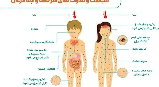 علائم ابله میمون در بزرگسالان عکس