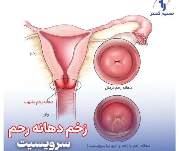 رحم عکس واضح از زگیل تناسلی زنان نی نی سایت