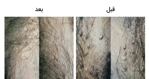 عکس های زگیل تناسلی در مردان