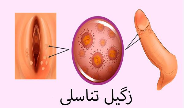عکس های زگیل تناسلی در مردان