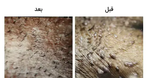 عکس های زگیل تناسلی در مردان