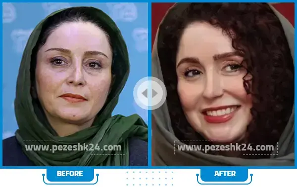 عکس ژاله صامتی قبل عمل