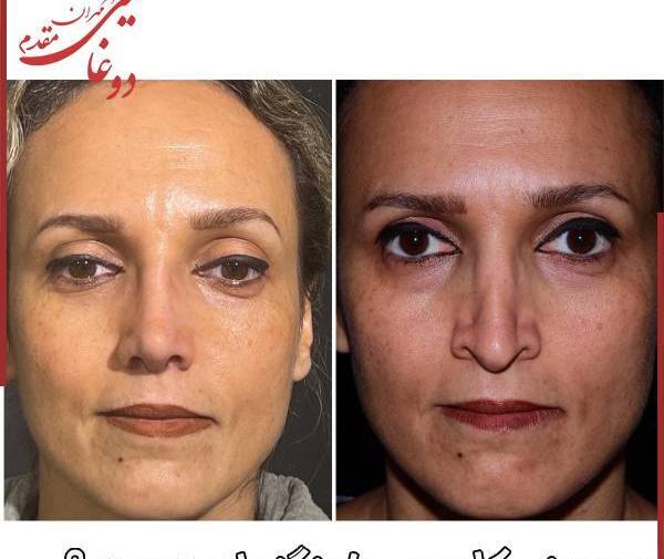 عکس آمپول تریام هگزال ایرانی
