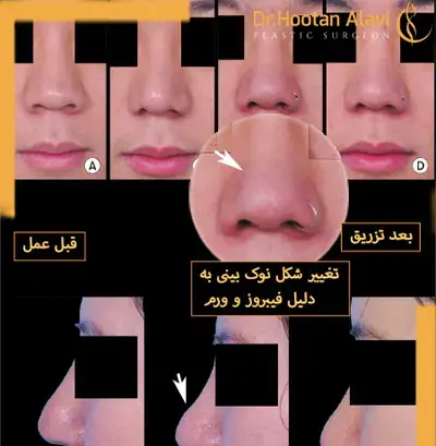 عکس آمپول تریام هگزال ایرانی