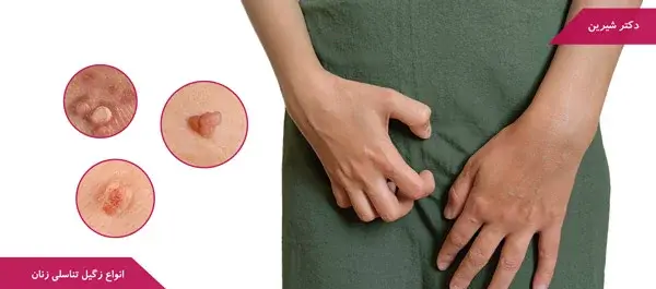 عکس زگیل تناسلی در زنان داخل واژن