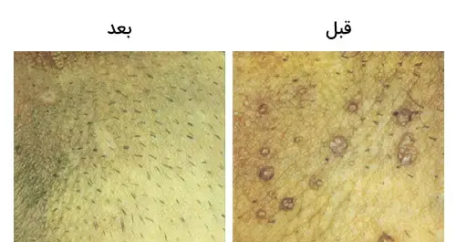 عکس زگیل تناسلی در زنان داخل واژن