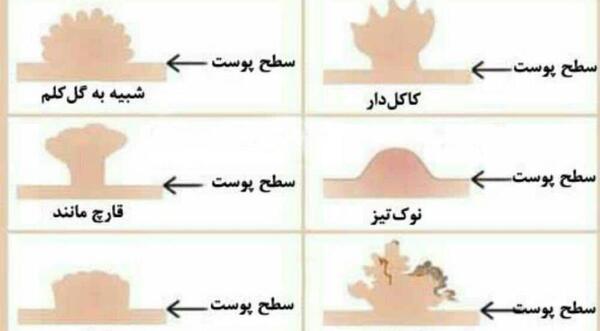 عکس زگیل تناسلی در زنان و مردان