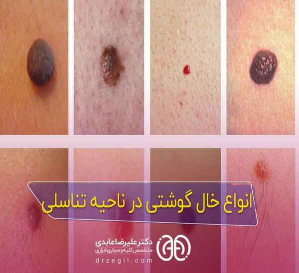 عکس زگیل تناسلی در زنان و مردان