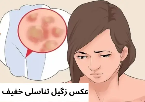 عکس زگیل تناسلی در زنان خفیف