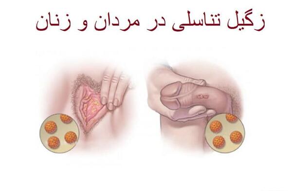 عکس زگیل تناسلی در زنان درمان