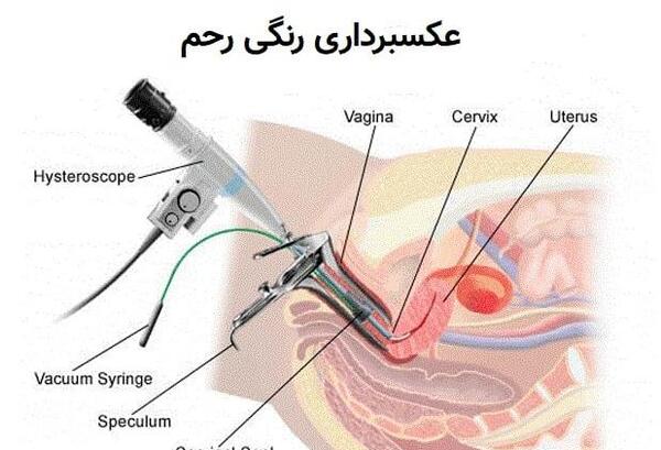 عکس رنگی رحم برای چیست
