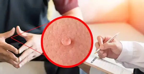 عکس زگیل تناسلی کم خطر در زنان