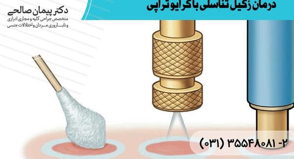 عکس زگیل تناسلی بعد از کرایو